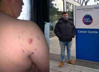 Uncover the Misdiagnosis of a Cancerous Itchy Lump news-18102024-043111