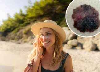 Revolutionizing Skin Cancer Detection with AI: University of Essex Study news-21102024-045657